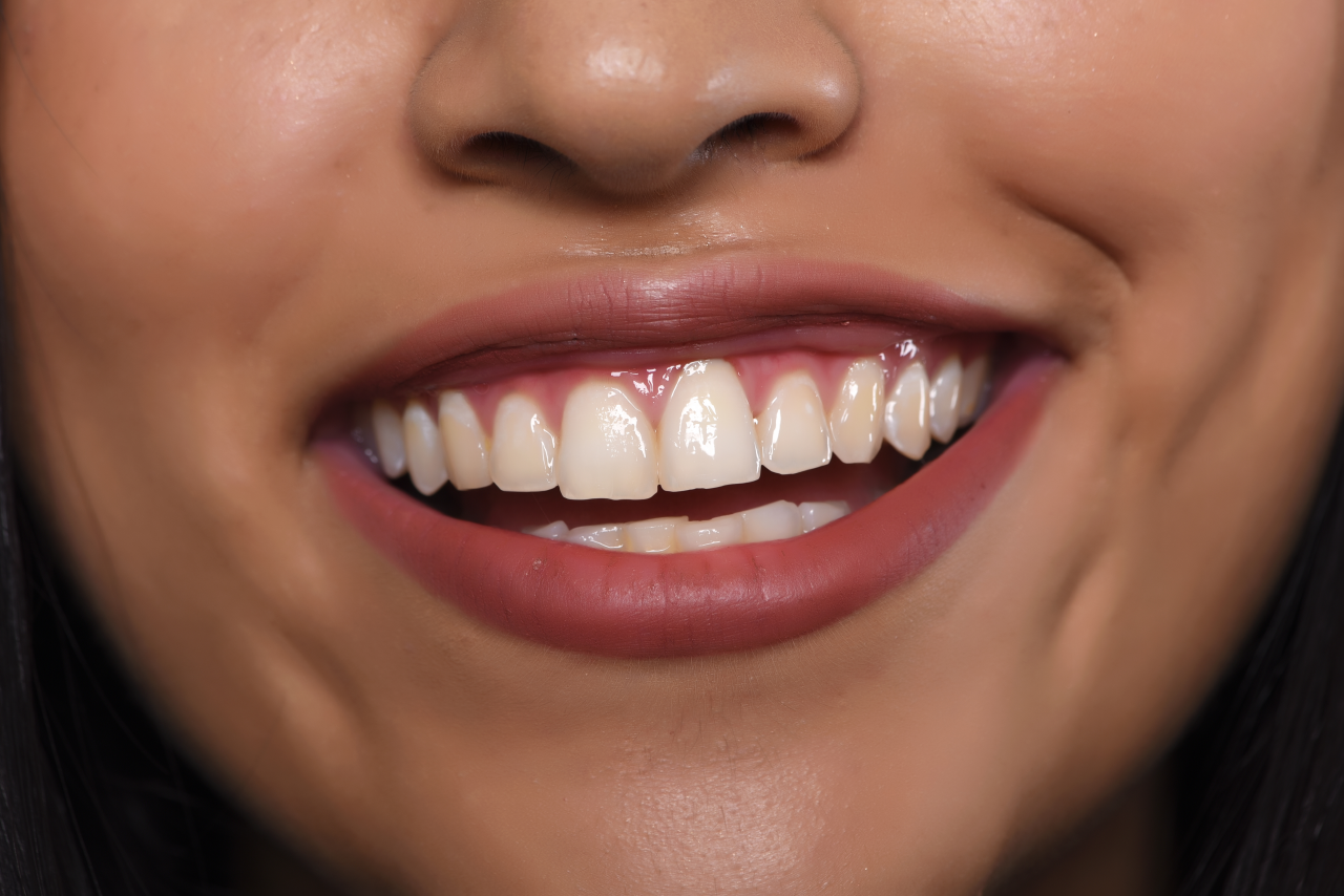 Metal Substructure Porcelain