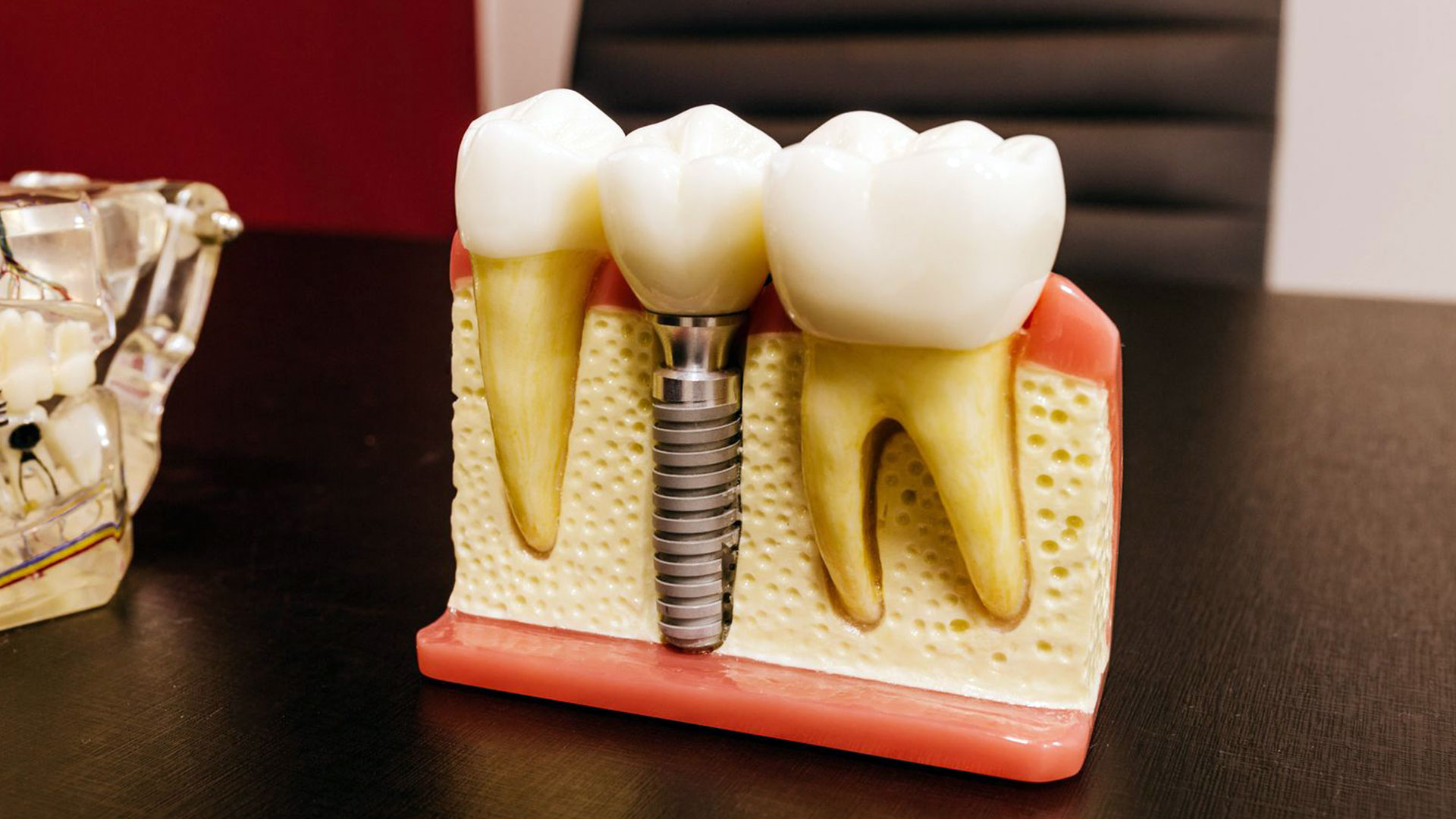 Ideal Implant brands