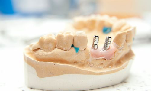 Implantat bei Knochenmangel